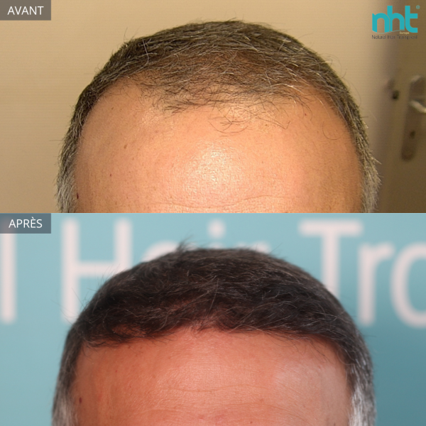 Greffe de Cheveux à Avignon, Résultat Greffe 4500 greffons à 1 an