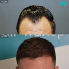 Résultat d’une greffe de cheveux modérée