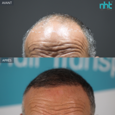 Résultat d’une méga greffe de cheveux de 6000 greffons