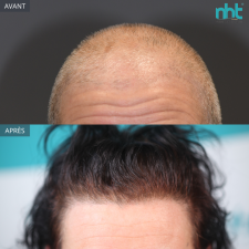 Giga greffe de cheveux sur une femme de 50 ans