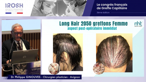 Le Docteur Philippe GINOUVES, orateur au congrès IROSH : Focus sur la greffe de cheveux longs sans rasage