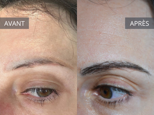 Greffe de sourcils après un tatouage des sourcils et microshading