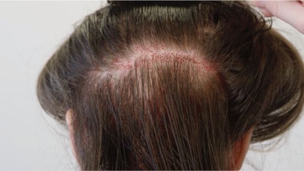 Implant Capillaire avec la Greffe de Cheveux sans Rasage à Lyon