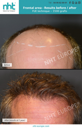 Result before after hair transplant FUE 3500 grafts