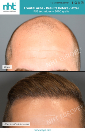 Result before after hair transplant FUE frontal area 5000 grafts