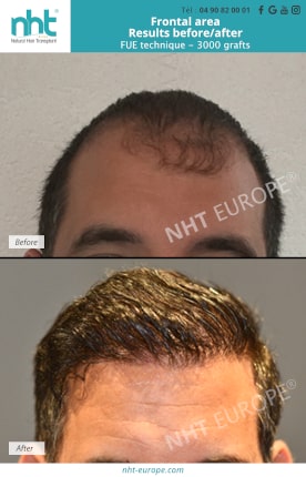 Result before after hair transplant FUE frontal area 3000 grafts