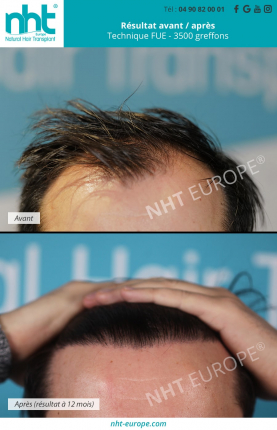résultat greffe de cheveux avant après à 1 an technique dhi fue 3500 greffons