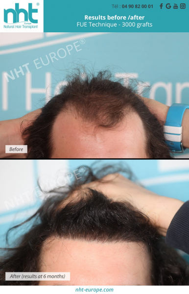 hairtransplant 3000 grafts before after results at 6 months