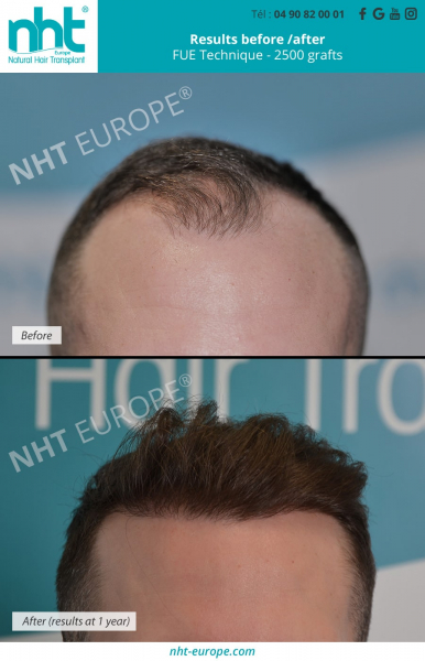 hair-transplant-2500-grafts-resultats-before-after-1-year-evolution-hair-line-hairgrowth-baldness-solution