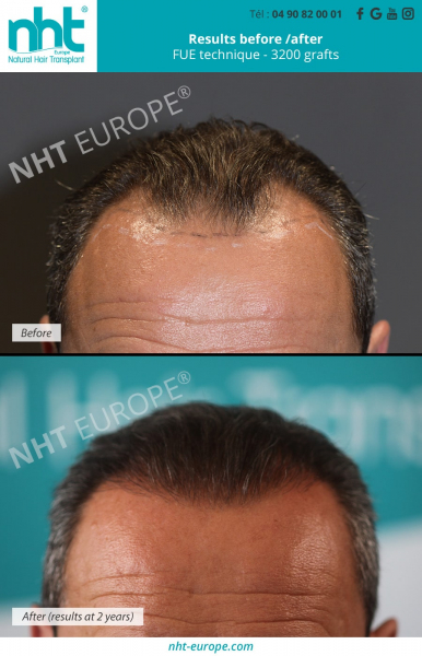 results-before-after-3200-grafts-hair-transplant-transplantation-fue-technique-at-2-years-france-avignon-hair-men-man-hairloss-solution-baldndess-frontline-hair-line-density-thick-hair-bald-long-hair-nht-europe