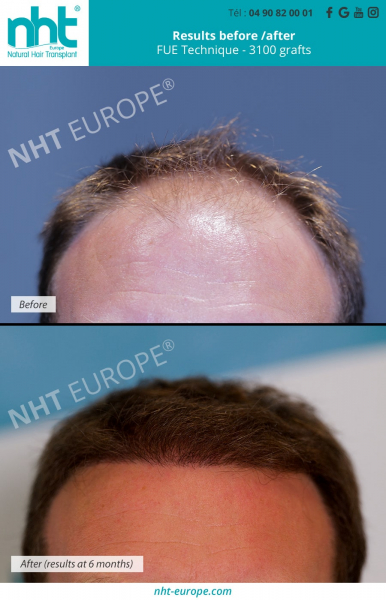before-after-results-hair-transplant-fue-technique-dhi-3100-grafts-hairgrowth-baldness-solution-frontal-area-men-man-hairloss-france
