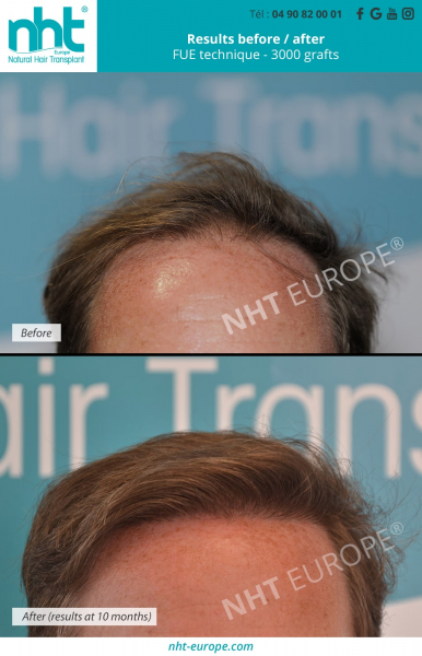 hair-transplant-results-before-after-3000-grafts-fue-dhi-technique-at-10-months-hair-growth-thicker-longer-frontal-area-hairgraft-in-france-avignon