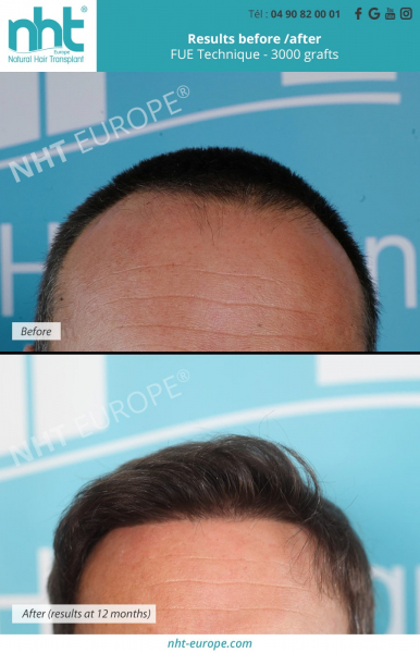 frontal hairline hairtransplant 3000 grafts nht europe