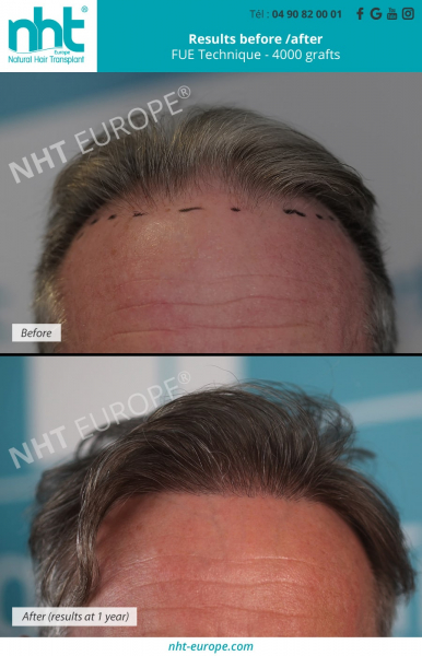 4000-grafts-hair-transplantation-fue-dhi-technique-before-after-results-at-1-year-
