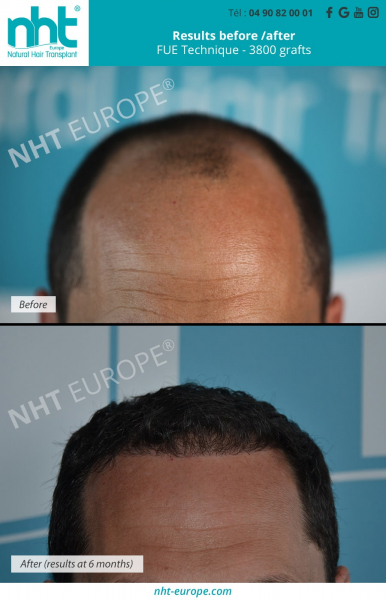 baldness solution hair transplant 3800 grafts results before after