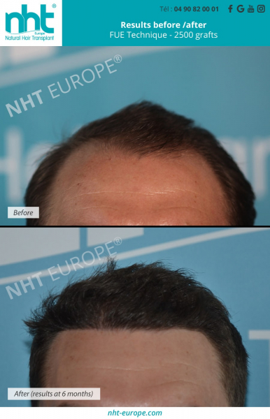 2500 grafts hair transplant hairline fue dhi technique before after results