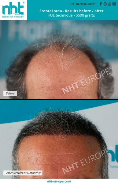 hair-transplant-on-grey-hair-5500-grafts-mega-session-before-after-results-fue-dhi-technique-frontal-area-top-of-the-head-hairloss-alopecia-baldness-man-in-france