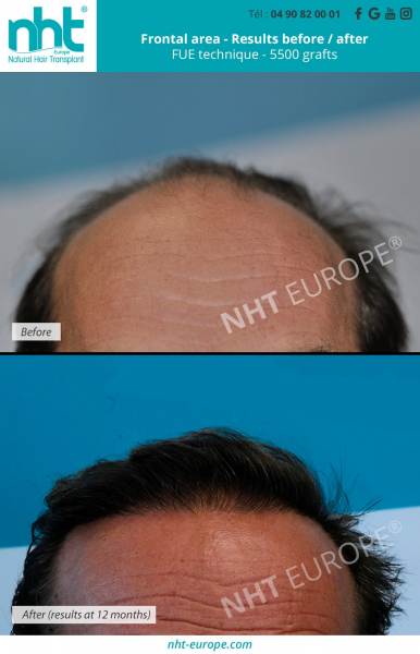 frontal-area-hair-transplant-with-5500-grafts-fue-dhi-technique-results-before-after-mega-session-baldness-solution-hair-loss-hair-fall-hair-regrowth-hair-plug