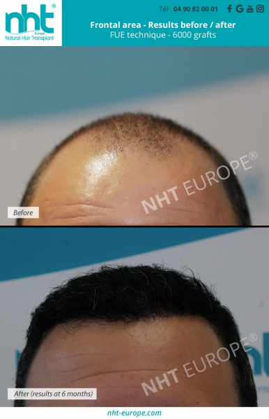 hair-implant-frontal-area-with-6000-grafts-fue-dhi-technique-results-before-after-hailoss-baldness-solution