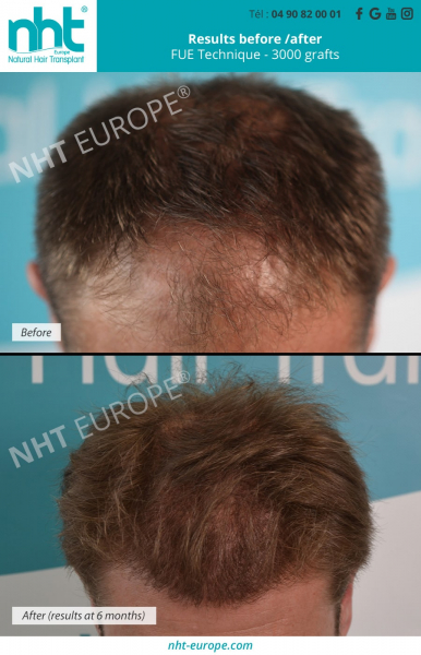 3000-grafts-hair-transplantation-fue-dhi-technique-before-after-results-at-6-months