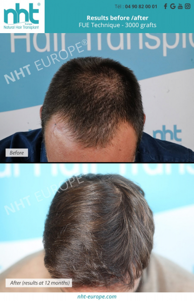 hairtransplant on young patient 3000 grafts before after results nht europe france