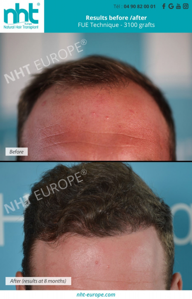 hairline hair transplantation before after results hairloss solution