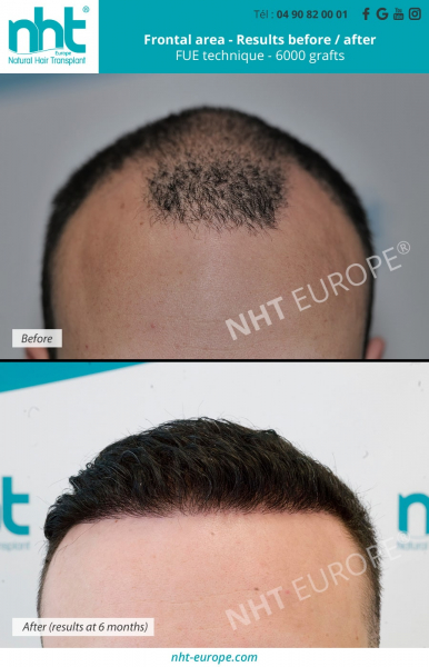frontal-area-hair-transplant-6000-grafts-fue-dhi-technique-results-at-6-months-france