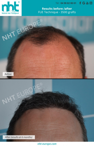 fue hair transplant hairline 3500 grafts at 6 months