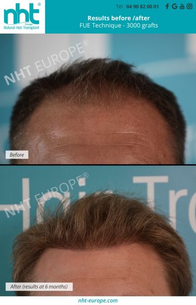 hair-transplant-3000-grafts-fue-dhi-technique-best-clinic-hair-loss-treatment