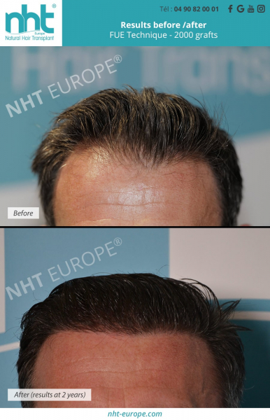 hairline correction by hairtransplant with 2000 grafts before after results