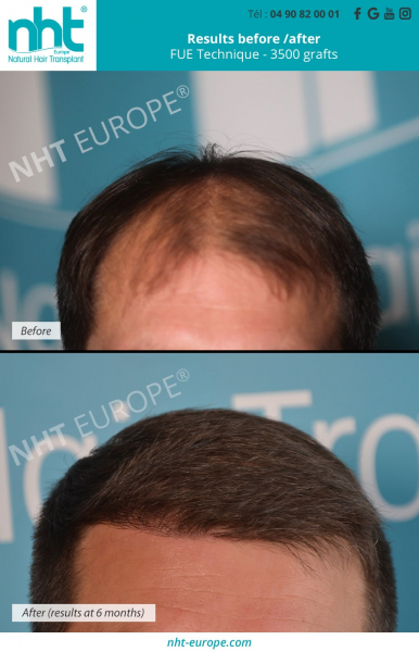 before after hairtransplant 3500 grafts frontal area at 6 months hairgrowth