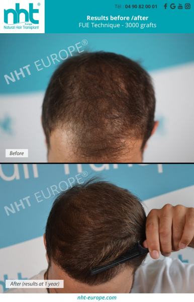 3000 grafts hair restoration hair transplant before after results
