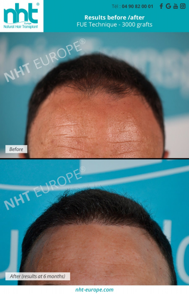 hairline transplant 3000 grafts at 6 months before after pictures