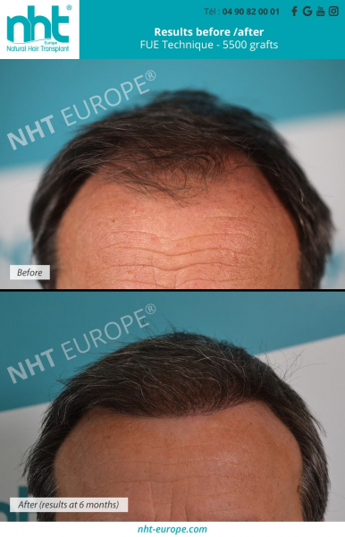frontal-area-hair-transplant-with-5500-grafts-fue-dhi-technique-before-after-results-at-6-months