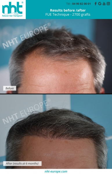 hairtransplant on grey hair results before after dhi fue