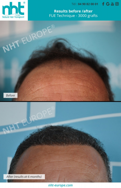 frontline hairtransplant 3000 grafts fue technique man