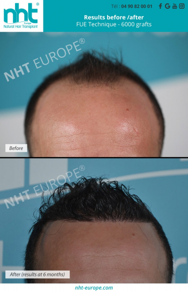 6000 grafts hairtransplant megasession