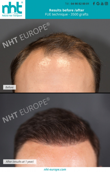 hair-transplant-of-3500-grafts-on-the-frontline-before-skull-result-a-1-year-clinic-capillary-avignon-south-of-France