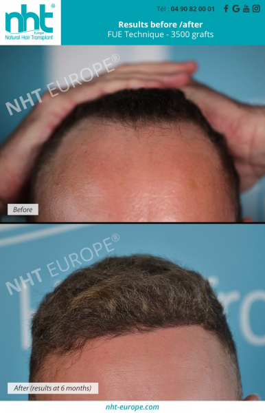 hairline hair transplant 3500 grafts baldness and hairloss solution