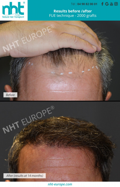 Before/After Results Hair Transplant for Men and Women