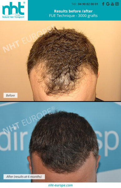 results before after hairgrafting