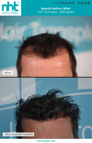 gulfs hairtransplant 2800 grafts baldness solution