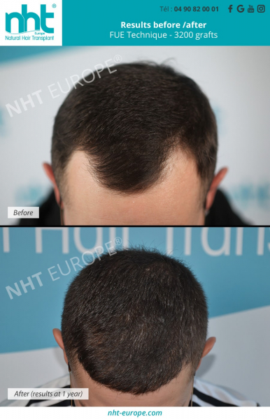 hairtransplant 3200 grafts hairloss solution on hairline before after results