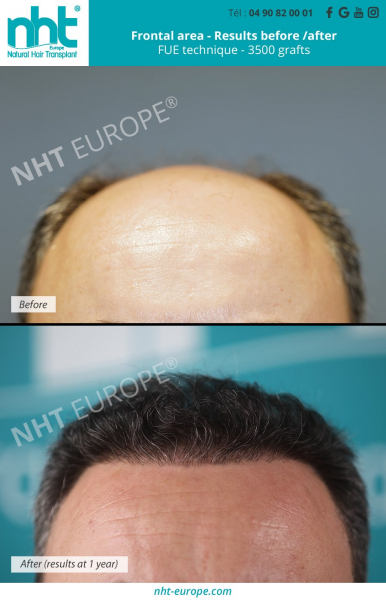 frontal-area-hairtransplant-3500-hairgraft