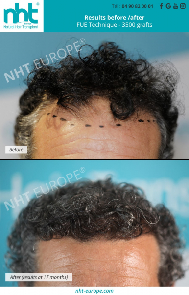 hair-transplant-on-curly-hair-forehead-frontal-area-results-before-after-at-17-months-3000-grafts-fue-dhi-technique-baldness-and-hairloss-solution-hairgrowth-france