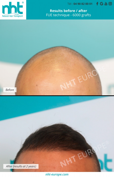 Photo showing the results of a hair transplant 2 years after surgery with 6000 grafts