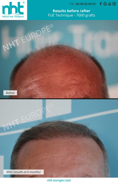 hairtransplantation fue dhi technique 7000 grafts at 6 months