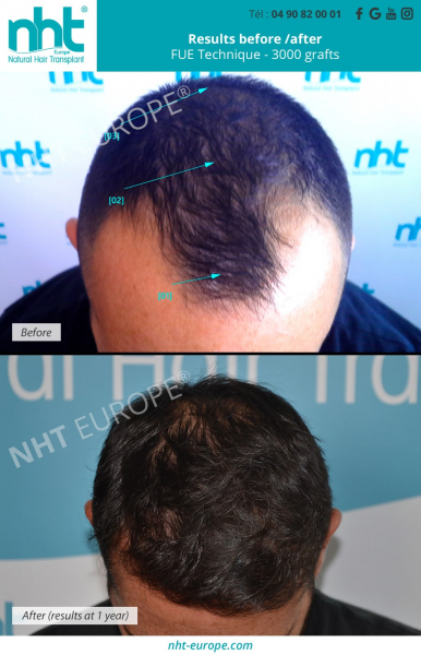 hair transplant frontal area fue dhi technique man results at 1 year
