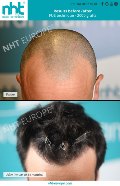 hair-transplant-2000-temporal-grafts-frontline-front-result-before-14-months-growth