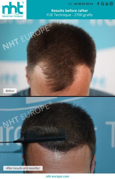 hairline hairtransplant 2700 grafts young man fue dhi technique